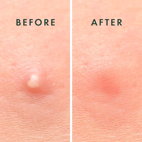 Rael Pimple Patches, Miracle Invisible Spot Cover - Hydrocolloid Acne Patch, Treatment for Breakouts, Absorbs Zits & Blemish, Korean Skin Care, 2 Sizes (96 Count)