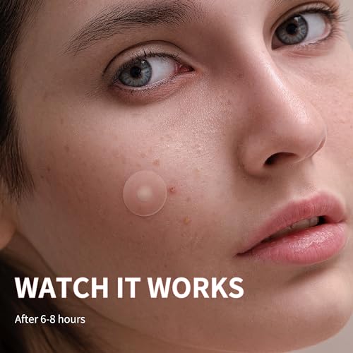 Pimple Patches for Face, 3 Size 510 Counts Hydrocolloid Acne Patches for Covering Zits and Blemishes, Spot Stickers with Salicylic Acid, Tea Tree Oil & Calendula Oil(8mm,10mm,12mm)