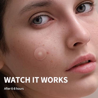 Pimple Patches for Face, 3 Size 510 Counts Hydrocolloid Acne Patches for Covering Zits and Blemishes, Spot Stickers with Salicylic Acid, Tea Tree Oil & Calendula Oil(8mm,10mm,12mm)