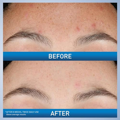 CeraVe Resurfacing Retinol Serum For Post Acne Marks, Formulated With Licorice Root Extract & Niacinamide, Brightening Serum & Pore Minimizer For Face, Post Acne Skin Barrier Repair, Non-Comedogenic
