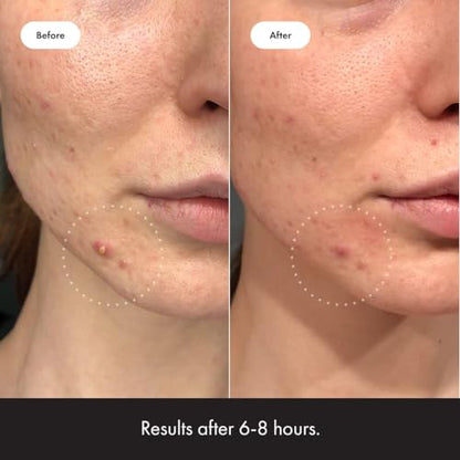 Mighty Patch™ Invisible+ Patch - Daytime Hydrocolloid Acne Pimple Patches for Covering Zits and Blemishes, Ultra Thin Spot Stickers for Face and Skin (24 Medium and 15 Small Patches)