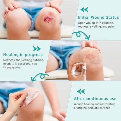 Upadated Hydrocolloid Bandages,2in*5ft Hydrocolloid Roll for Wound Care,Medical-Grade Hydrocolloid Patch Bandages with Self-Adhesive, Flexible & Waterproof DIY Size & Shape (2in*10ft)