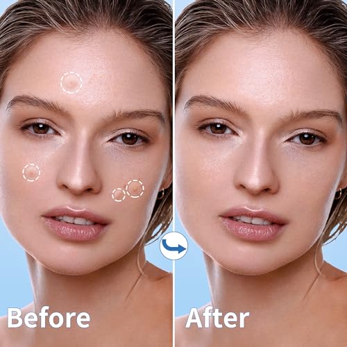 Pimple Patches for Face, 3 Size 510 Counts Hydrocolloid Acne Patches for Covering Zits and Blemishes, Spot Stickers with Salicylic Acid, Tea Tree Oil & Calendula Oil(8mm,10mm,12mm)