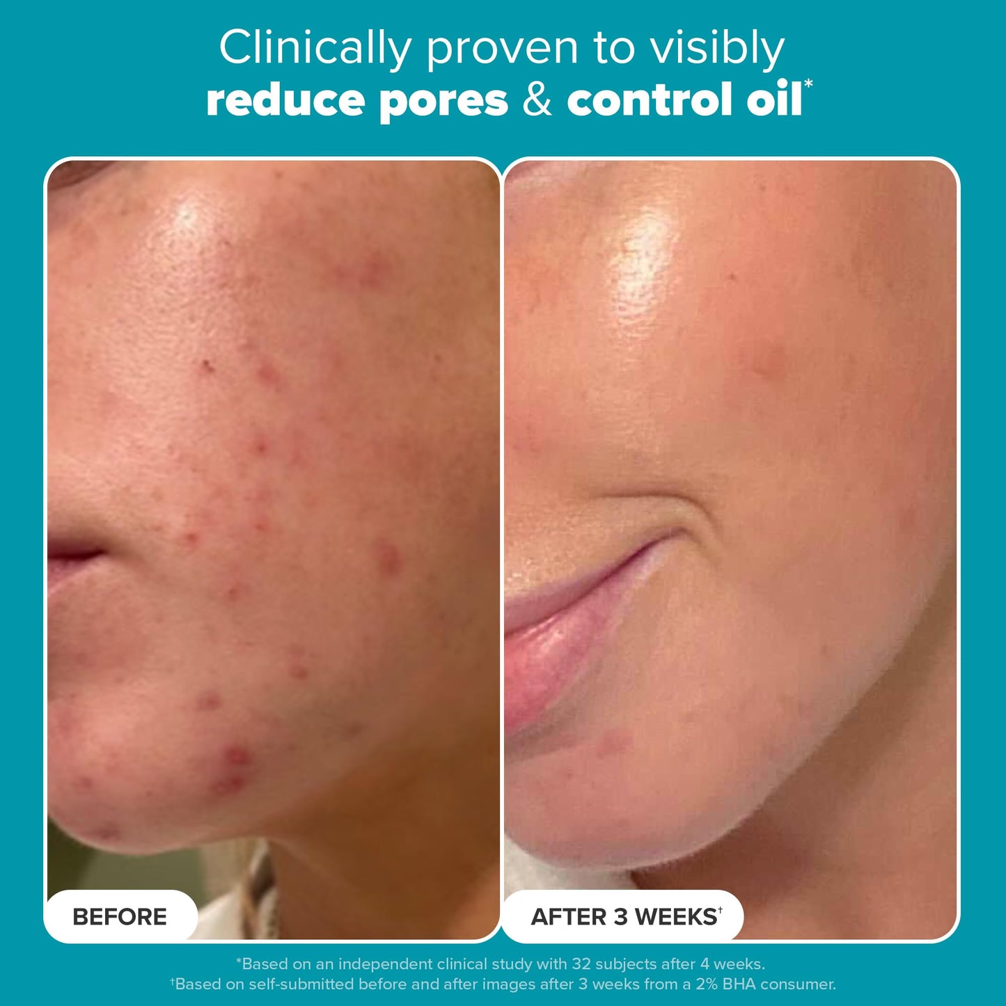 Paula's Choice Skin Perfecting 2% BHA Liquid Salicylic Acid Exfoliant, Gentle Facial Exfoliator for Blackheads, Large Pores, Wrinkles & Fine Lines, Travel Size, 1 Fluid Ounce